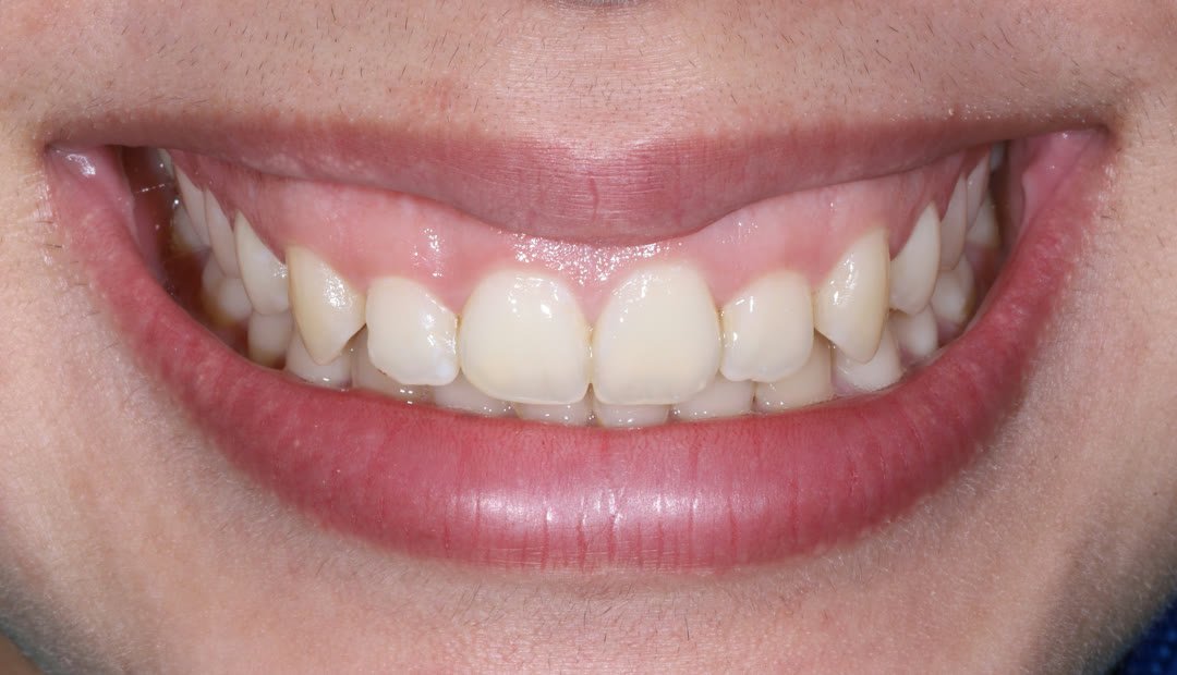 Antes: sonrisa con exceso de encía visible y dientes de aspecto corto