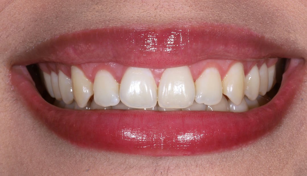 Después: la misma sonrisa tras remodelar el contorno gingival, con los dientes de proporción más larga