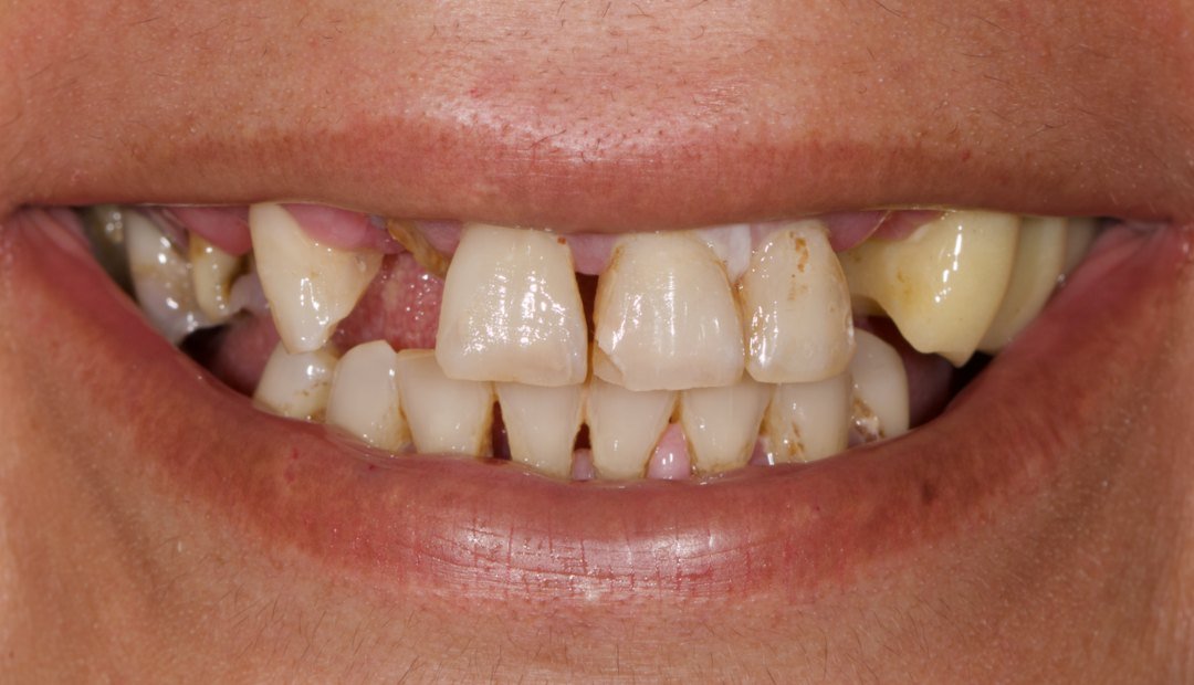 Antes: sonrisa con dientes fracturados, muy desgastados y con ausencias