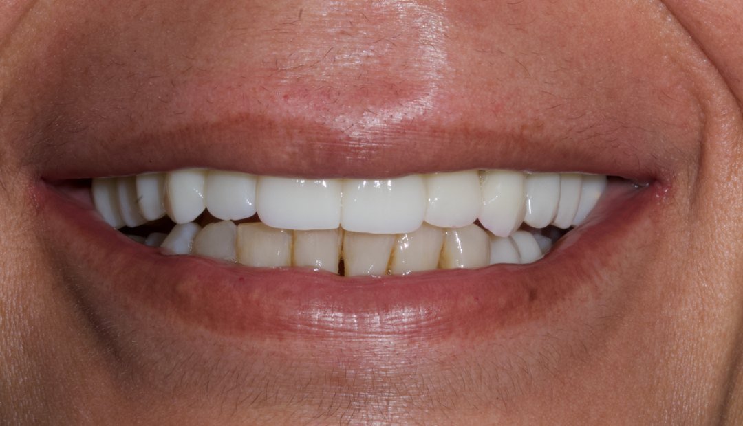 Después: la misma sonrisa el mismo día, con una prótesis provisional fija de arcada completa colocada sobre los implantes