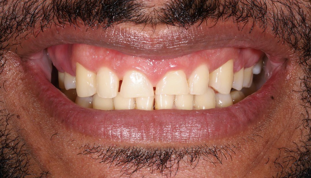Antes: sonrisa con los dientes amarillentos, desgastados y de bordes irregulares, con exceso de encía a la vista