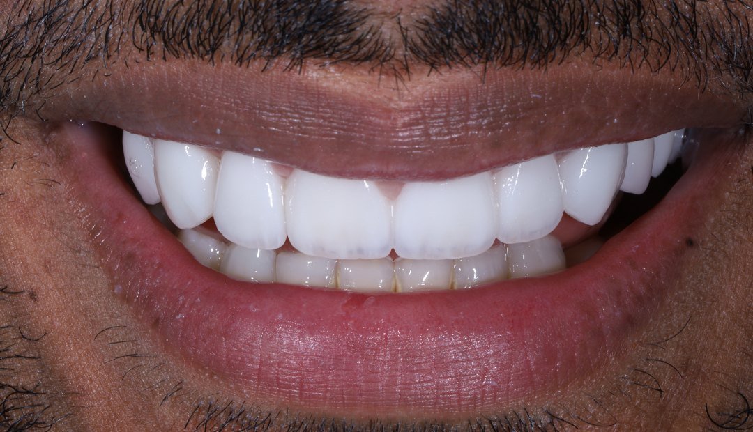 Después: la misma sonrisa con carillas de porcelana, de forma y color uniformes