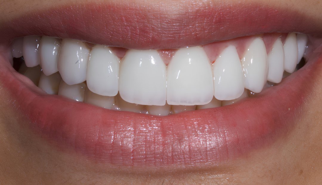 Después: la misma sonrisa con carillas ultrafinas, de bordes definidos y color uniforme