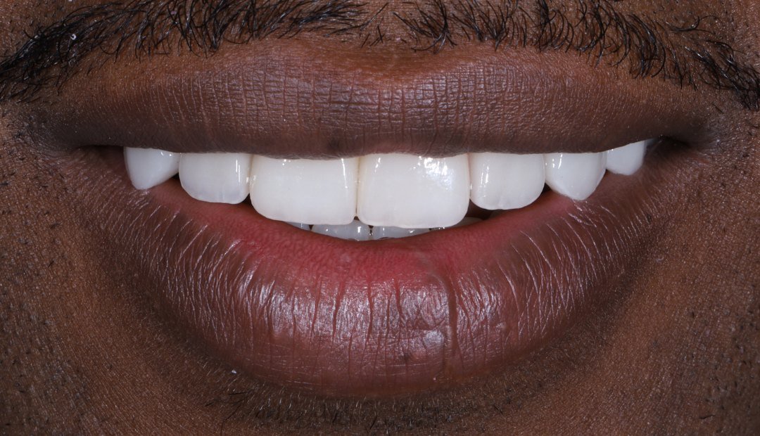 Después: la misma sonrisa con carillas y coronas sobre implantes, alineada y de color uniforme