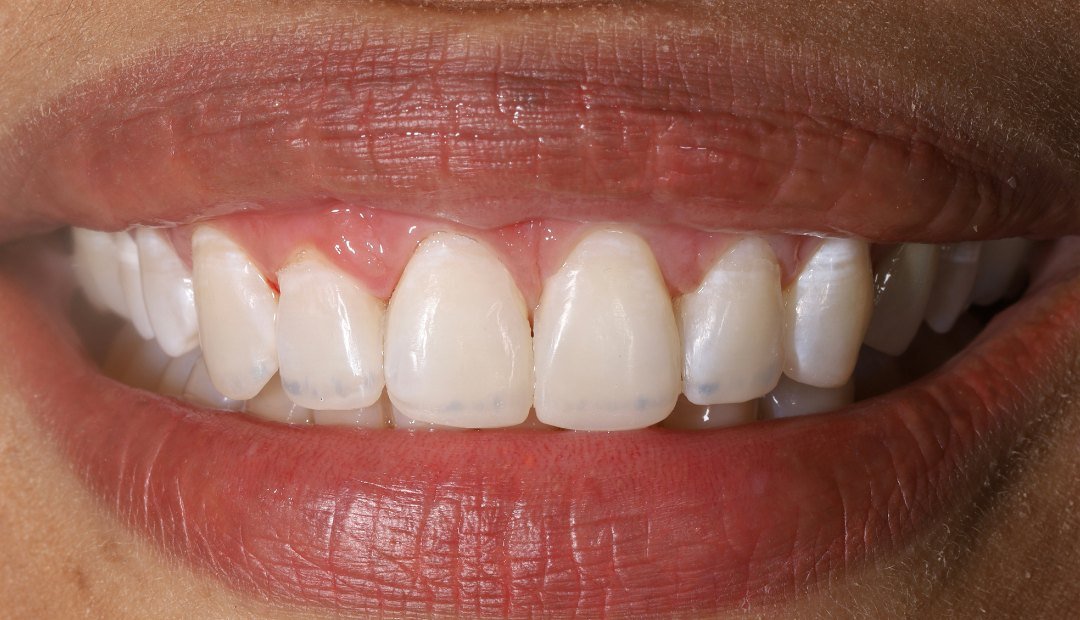 Después: la misma sonrisa restaurada con resina, con los bordes regulares y el color uniforme