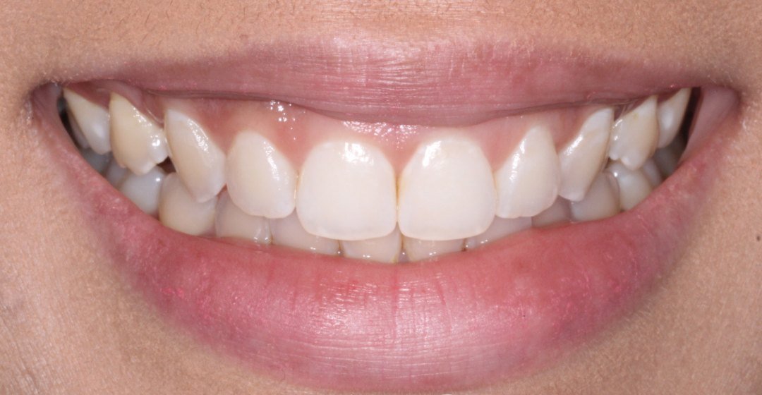 Antes: sonrisa con los dientes de proporciones desiguales y los laterales más pequeños