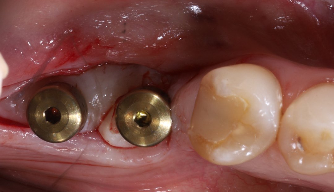 Antes: vista lateral de dos implantes con sus tapas de cicatrización, rodeados de encía fina y enrojecida