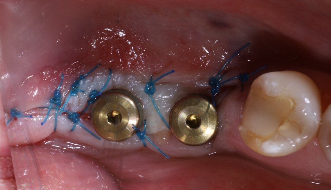 Después: los mismos dos implantes tras el injerto, con una banda de encía firme suturada alrededor