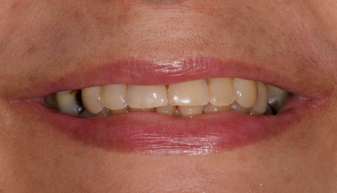 Antes: sonrisa con los dientes desgastados, desiguales y de tono amarillento