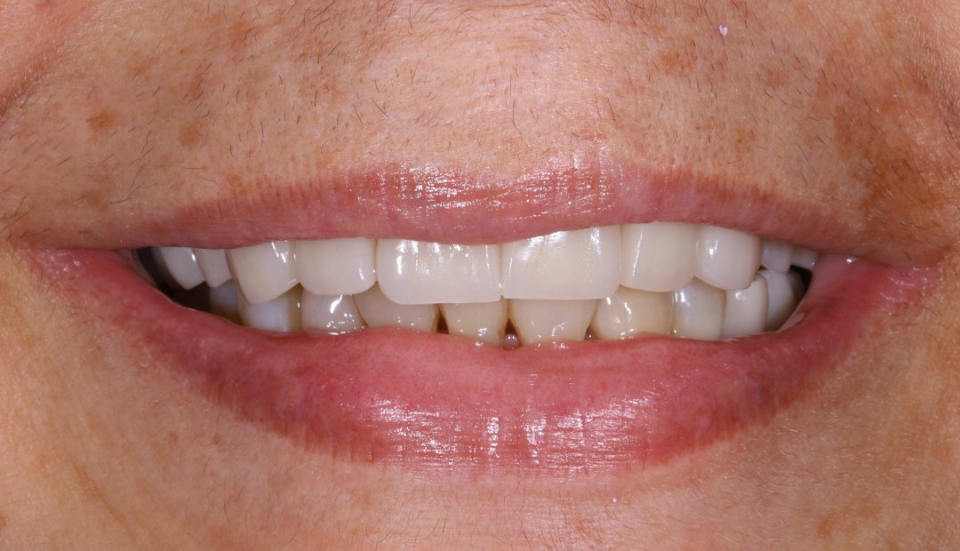 Después: la misma sonrisa rehabilitada con prótesis fija de zirconia, con los dientes uniformes y de tono más claro