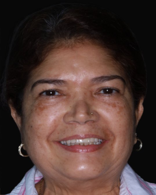 la misma paciente sonriendo tras la rehabilitación