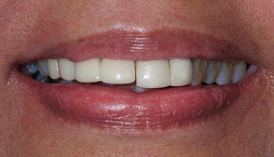 Antes: sonrisa con restauraciones antiguas, dientes de tonos desiguales y bordes desgastados