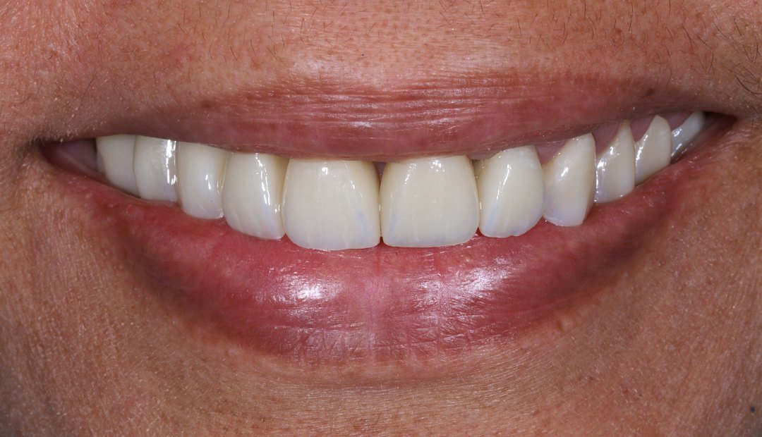 Después: la misma sonrisa rehabilitada por completo en zirconia, con los dientes alineados y de tono uniforme