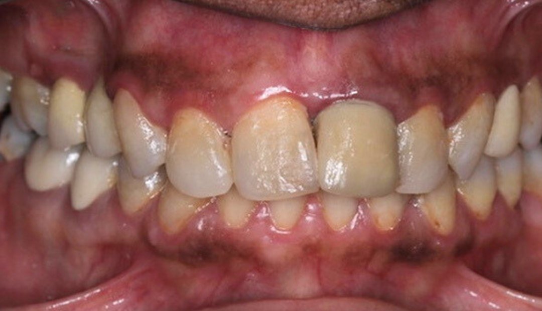 Antes: vista intraoral con separadores: dientes desgastados, de tonos desiguales y con la encía inflamada