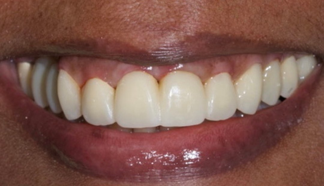 Después: la misma sonrisa con la prótesis provisional fija colocada y la encía en mejor estado