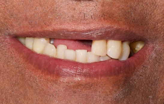 Antes: sonrisa con ausencias dentales y varios dientes desgastados