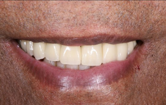 Después: la misma sonrisa con la arcada completa rehabilitada sobre implantes