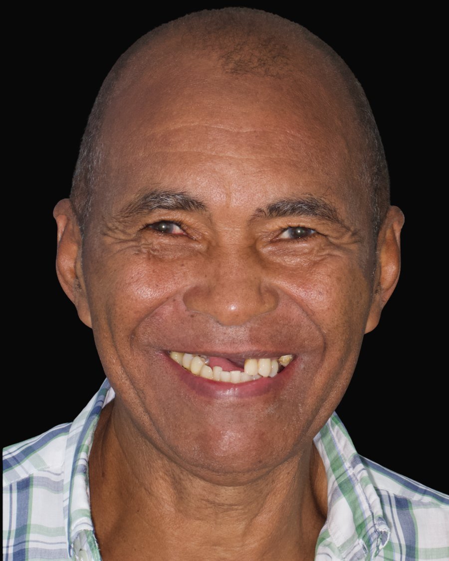 retrato del paciente sonriendo antes del tratamiento, con ausencias dentales visibles
