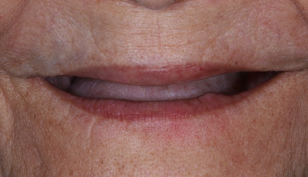 Antes: boca cerrada sin dientes, con los labios hundidos por la falta de soporte