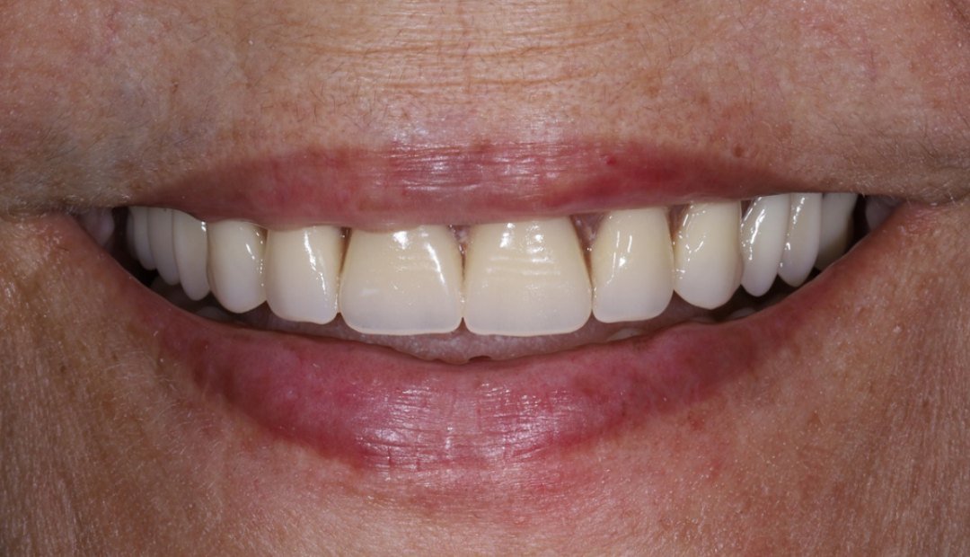 Después: la misma boca sonriendo con la sobredentadura puesta, con la arcada completa y los labios sostenidos